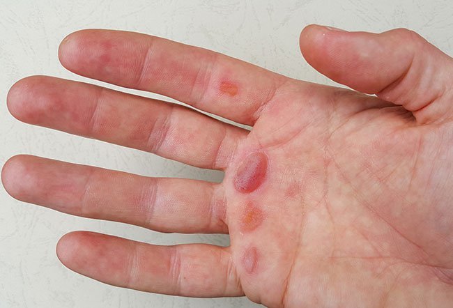 The most common causes of blisters on the hand include eczema, friction injury, irritation from chemicals or allergens, medication reaction, infections, burns, or diabetes. The most common causes of blisters on the hand include eczema, friction injury, irritation from chemicals or allergens, medication reaction, infections, burns, or diabetes.