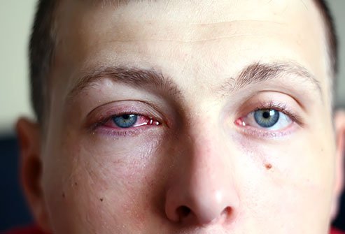 Eye infections can be bacterial or viral. They typically cause redness, swelling, discharge, watery eyes or general discomfort in the eyes. Eye infections can be bacterial or viral. They typically cause redness, swelling, discharge, watery eyes or general discomfort in the eyes.