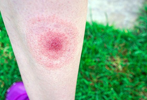 Lyme Disease Lyme Disease
