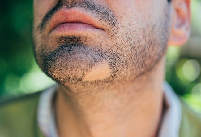 There is no cure for alopecia areata, but there are treatments available that some people find beneficial. There is no cure for alopecia areata, but there are treatments available that some people find beneficial.