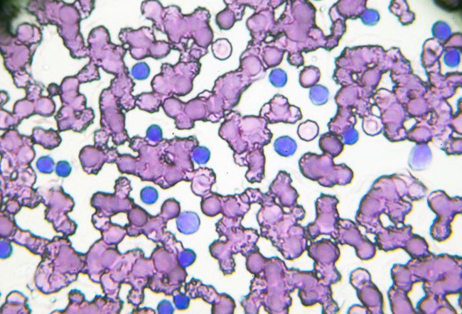 Chronic lymphocytic leukemia is a cancer of the blood and bone marrow.