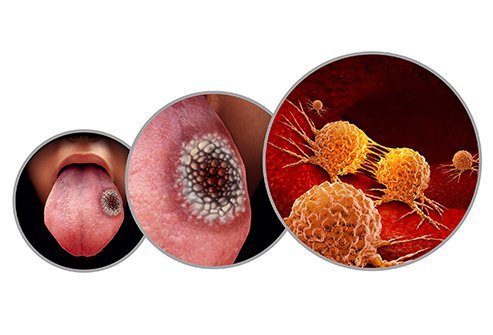 Tongue cancer is a serious form of oral cancer. In most patients, there may be a few to no symptoms in the early stages of tongue cancer. Tongue cancer is a serious form of oral cancer. In most patients, there may be a few to no symptoms in the early stages of tongue cancer.