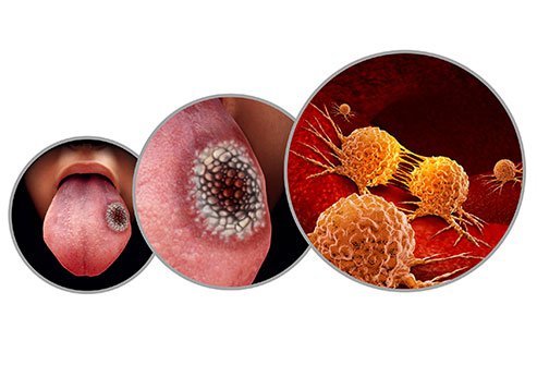 Mouth cancer is also referred to as oral cancer. 