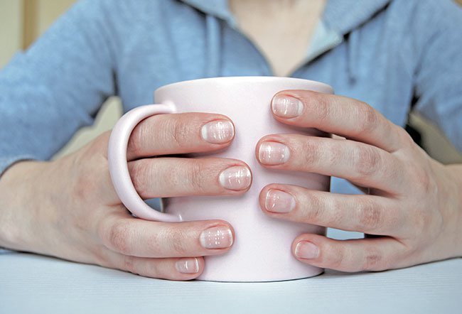 White nails are indicative of any or a combination of the conditions including anemia, overuse of nail polish, weak nails, kidney disease, heart disease, diabetes, rheumatoid arthritis and liver disease. White nails are indicative of any or a combination of the conditions including anemia, overuse of nail polish, weak nails, kidney disease, heart disease, diabetes, rheumatoid arthritis and liver disease.