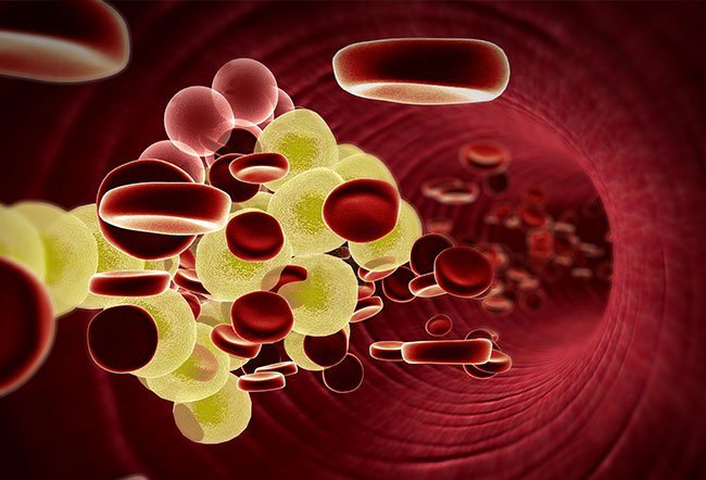 Hyperlipidemia is the medical term for high cholesterol. Hyperlipidemia usually has no symptoms, so many people may not be aware that they have high cholesterol. Hyperlipidemia is the medical term for high cholesterol. Hyperlipidemia usually has no symptoms, so many people may not be aware that they have high cholesterol.