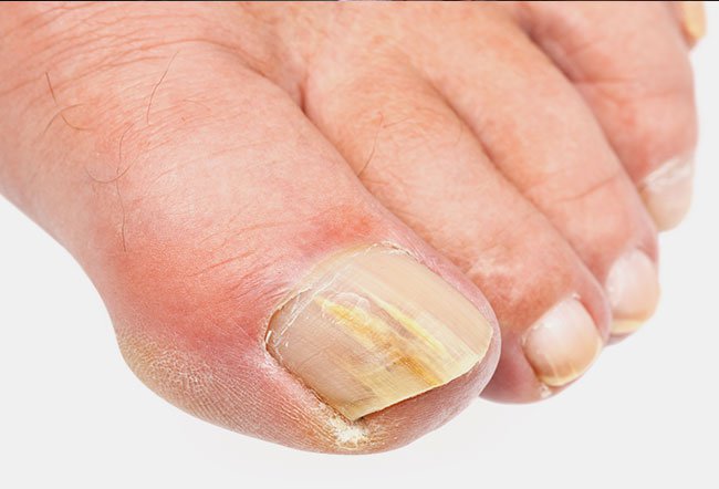 what does it mean when your toenails are yellow?