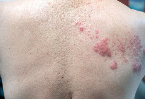 Shingles Rash