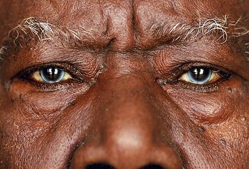 Eyes that contain multiple colors may be a sign of Waardenburg syndrome.