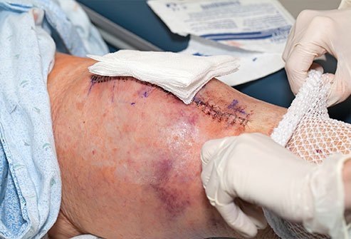 A compartment pressure measurement test A compartment pressure measurement test