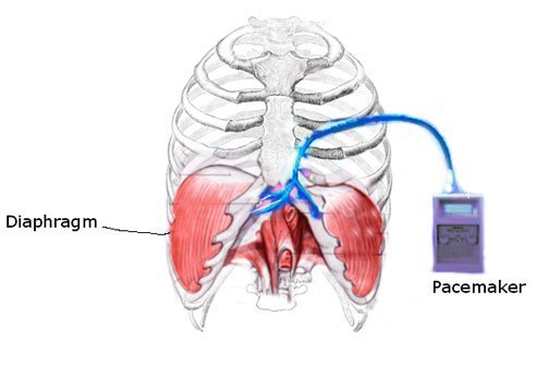 DPS can provide part-time or full-time respiratory support