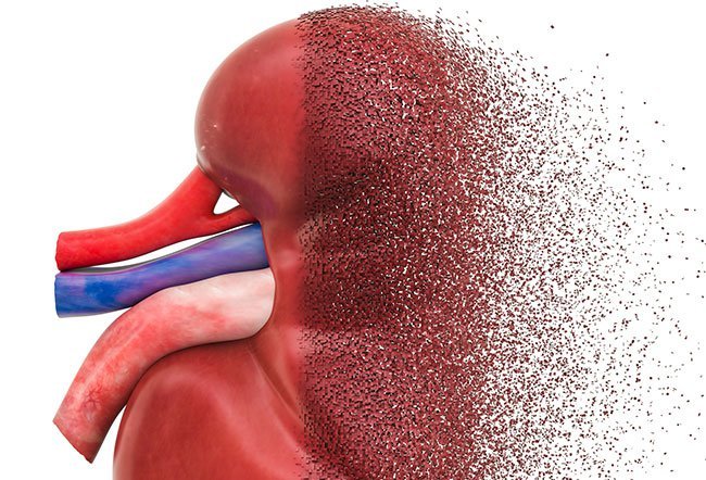 Berger's disease or immunoglobulin A (IgA) nephropathy is a kidney disorder