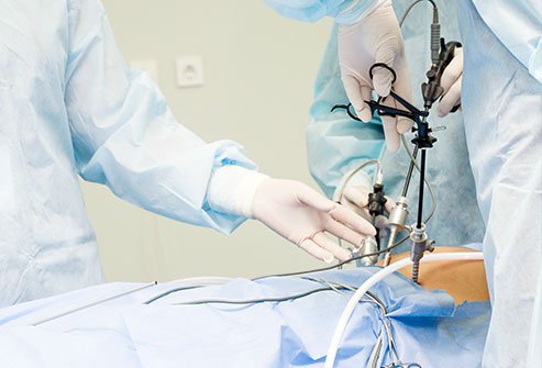 Laparoscopy Procedure