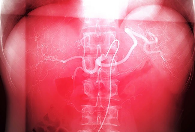 Embolization procedure