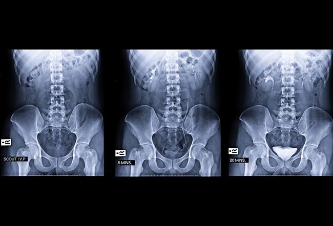 A kidney, ureter, and bladder (KUB) X-ray is a diagnostic test that can detect kidney stones and diagnose urinary tract disorders. A kidney, ureter, and bladder (KUB) X-ray is a diagnostic test that can detect kidney stones and diagnose urinary tract disorders.