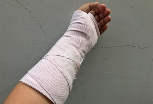 Short Arm Splint