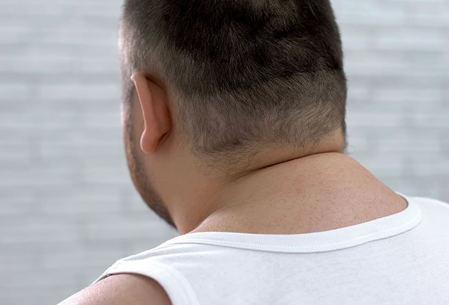 what causes a buffalo hump