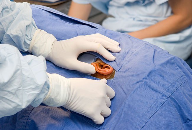 Meniere's disease surgery Meniere's disease surgery