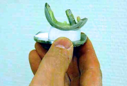 A unicompartmental knee arthroplasty (UKA) is a surgical procedure in which only the damaged parts of the knee are replaced in one of the knee compartments.