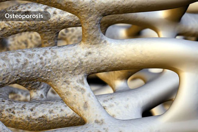 About 1 in 4 women -- and some men, too -- over 65 have osteoporosis, a bone-thinning disease.