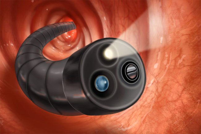 A doctor performs a colonoscopy to visualize the inside of your colon. 