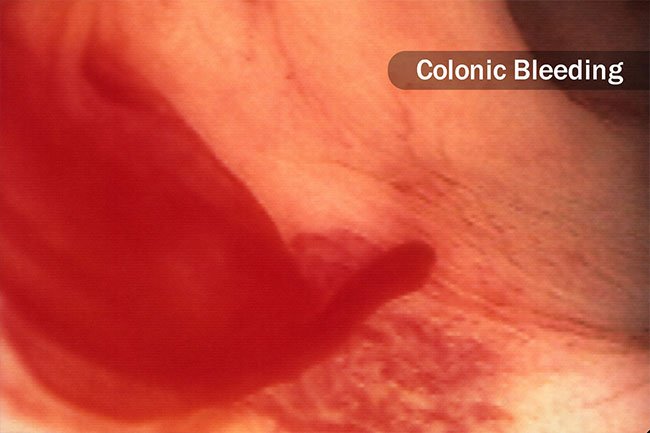 The risks of colonoscopies are rare, but you may have a reaction to the sedative, bleed if you have a biopsy or a polyp removed or you may suffer a tear in your colon or rectum.
