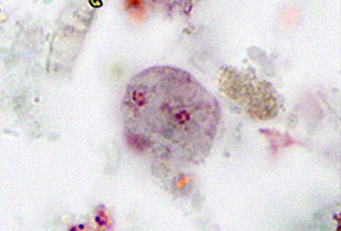Doctors aren't sure how you get this parasite, which infects your large intestine.