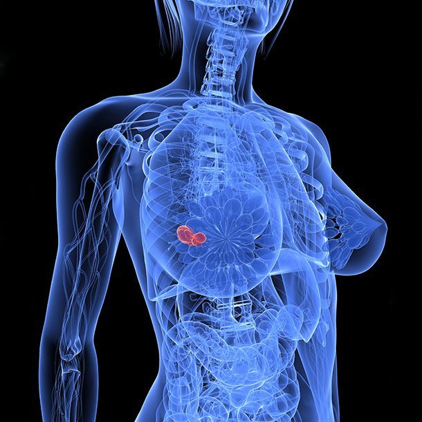 Fibrocystic Breast Condition