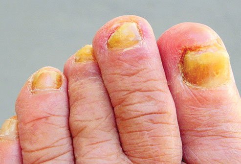 When toenails turn yellow, a fungus is usually to blame.