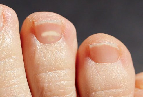 Stubbing your toe doesn't always lead to a bruise.