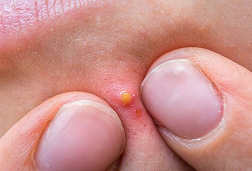 Boils are pus-filled bumps on your skin and develop when a hair follicle and the tissue around it become infected. Scratches, small nicks in the skin, popping a pimple, or even bug bites create openings for bacteria to enter a follicle resulting in a boil infection. 