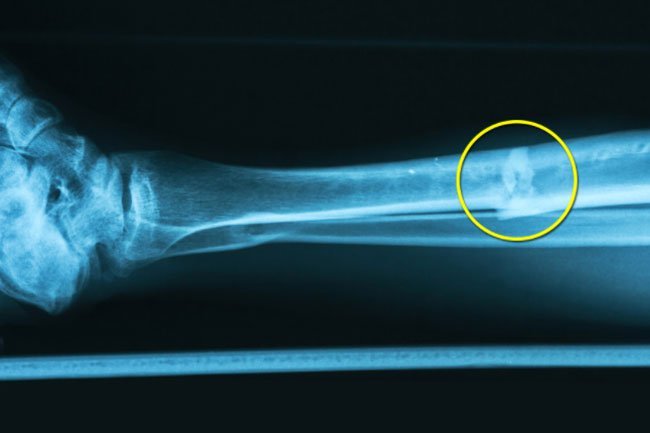 If you have a lower leg fracture, your calf may be tender, swollen, or bruised.