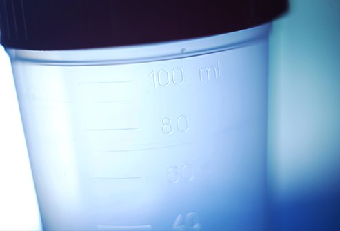 Different urine colors can be signs of kidney inflammation, diabetes, and other health issues.