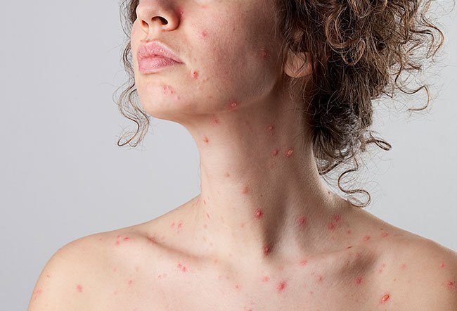 Chickenpox is a highly infectious disease that can have severe complications in adults. Adults are 25 times more likely to die from chickenpox than children are. Chickenpox is a highly infectious disease that can have severe complications in adults. Adults are 25 times more likely to die from chickenpox than children are.
