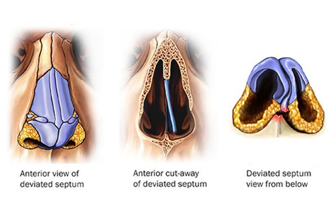 A deviated septum can make it harder for you to breathe and make you snore.