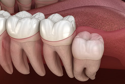 There is a fair amount of pain after wisdom tooth removal. The procedure is done under local anesthesia. The pain peaks six hours after the procedure and may last for a few days.