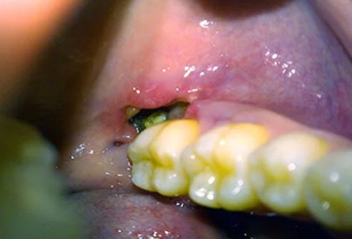 Dry socket is the most common complication of wisdom tooth removal.