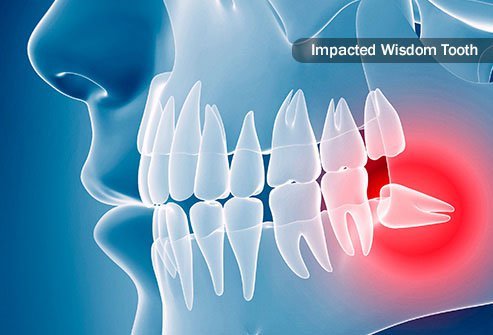 When teeth don't fully emerge from your gum line, they are considered impacted.