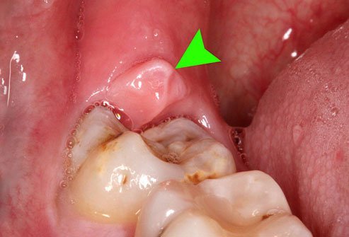 Gum pain and infection near wisdom teeth is known as pericoronitis.