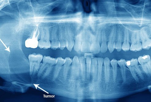 Cysts and tumors can result from impacted wisdom teeth (see area between arrows for cyst).