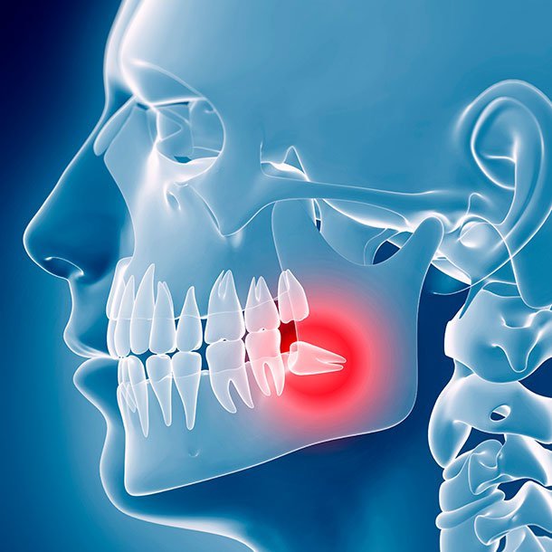 Hyperdontia is the condition of having an excess number of teeth. Impacted wisdom teeth count as extra teeth. Hyperdontia is the condition of having an excess number of teeth. Impacted wisdom teeth count as extra teeth.