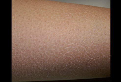 Picture of Xerosis