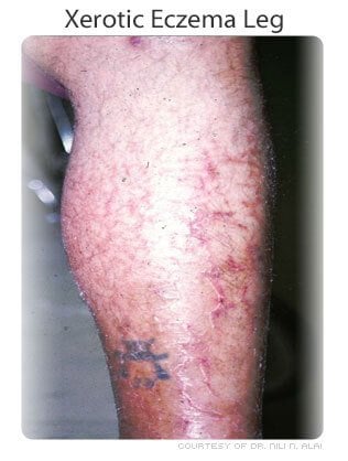 Xerotic eczema on the leg