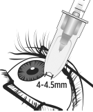 Identify the injection site by measuring 4 – 4.5 mm posterior to the limbus using the tip of the needle cap or ophthalmic calipers - Illustration
