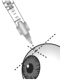 Insert the needle through the conjunctiva into the sclera - Illustration