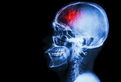 Facial paralysis is sometimes caused by stroke, a serious medical emergency.