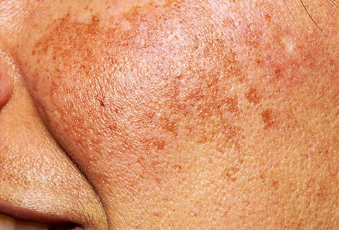 Brown and brownish-gray skin patches may be a symptom of melasma, also called chloasma.