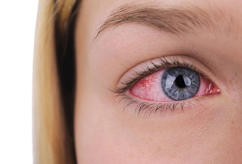 Bloodshot eyes may indicate a minor burst blood vessel or a more serious condition like glaucoma.