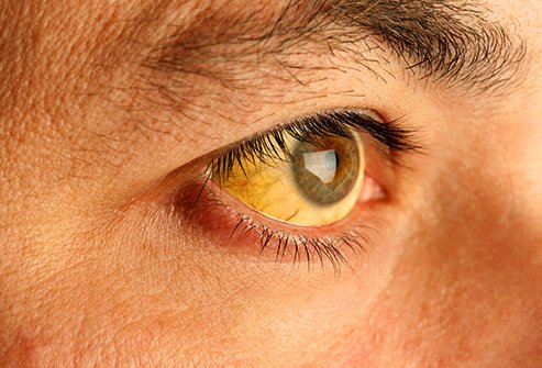 Yellow eyes and skin can be a sign of jaundice.