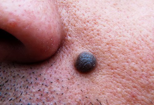 Strange looking moles may indicate skin cancer.