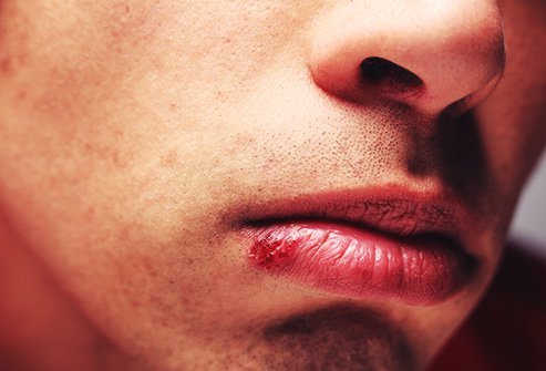 Cold sores affect two out of every three adults under age 50 worldwide.